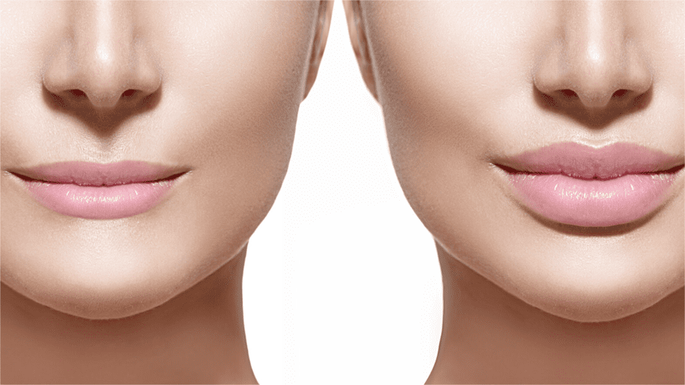 Коррекция губ и контурная пластика лица